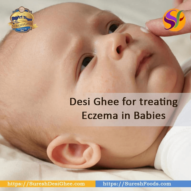 desi ghee for treating eczema : SureshDesiGhee.com